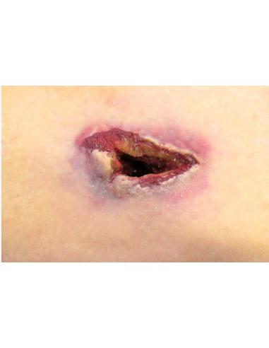 Artilerijos sviedinių skeveldrų padarytų žaizdų simuliatorius SHRAPNEL WOUND IN A BOX™