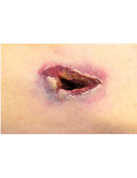 Artilerijos sviedinių skeveldrų padarytų žaizdų simuliatorius SHRAPNEL WOUND IN A BOX™