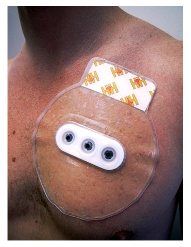 Okliuzinis Krūtinės Žaizdų Tvarstis H&H BOLIN CHEST SEAL