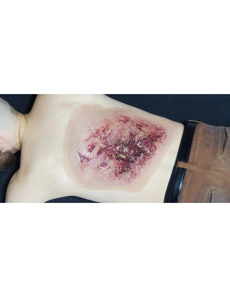 Realistic torso burn wound model for trauma simulation