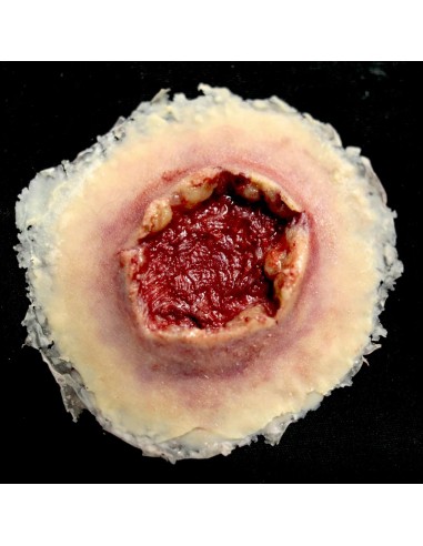 Large gunshot exit wound simulation for medical training