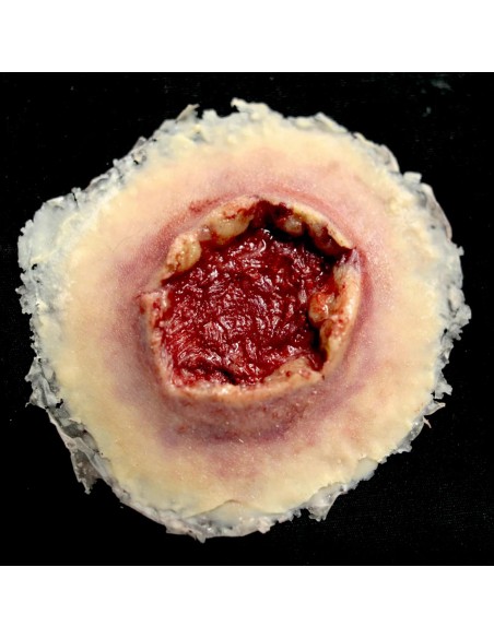 Large gunshot exit wound simulation for medical training
