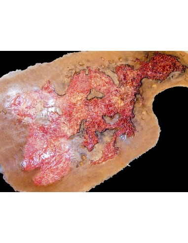Third degree chest burn simulation for medical training