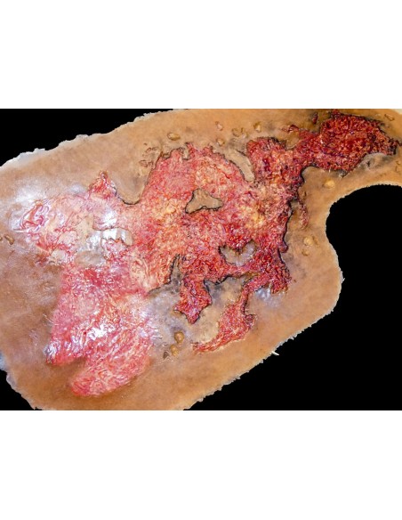 Third degree chest burn simulation for medical training