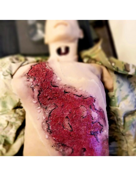 Thermal burn third degree chest wound model