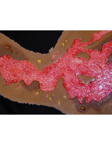 Third degree chest burn simulation for medical training