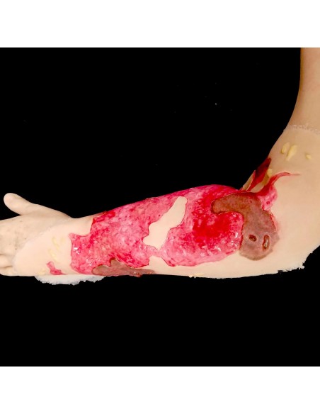 Third degree hand burn simulation for medical training