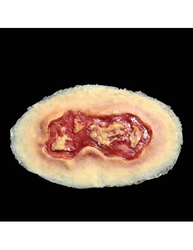 Vidutinė Elektros Nudegimo Žaizdos Imitacija
