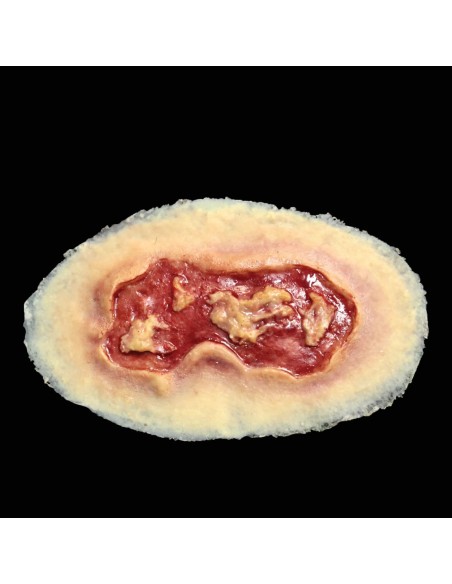 ELECTRICAL BURN- MEDIUM