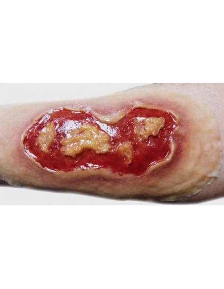 ELECTRICAL BURN- MEDIUM