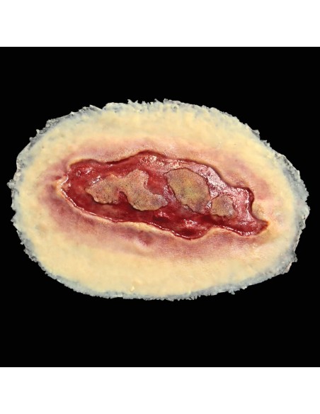 ELECTRICAL BURN- LARGE