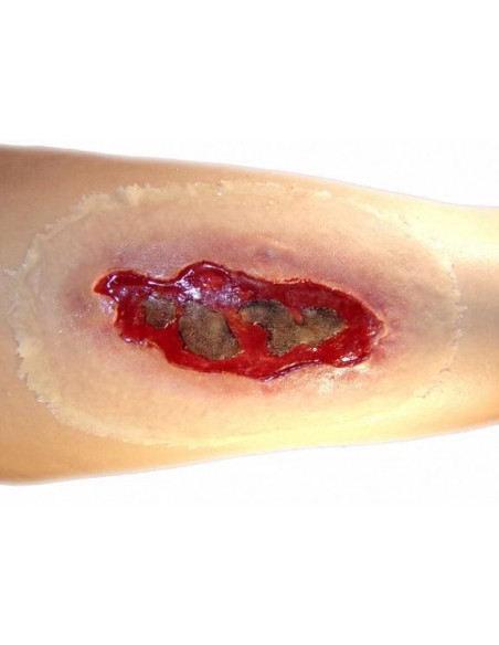 ELECTRICAL BURN- LARGE