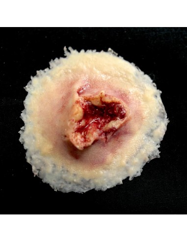 GUNSHOT EXIT WOUND – MEDIUM