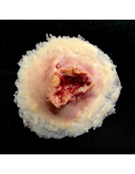 GUNSHOT EXIT WOUND – MEDIUM