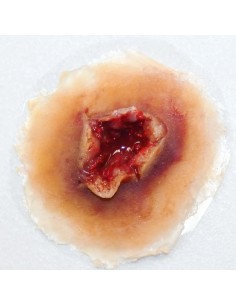 GUNSHOT EXIT WOUND – MEDIUM 2