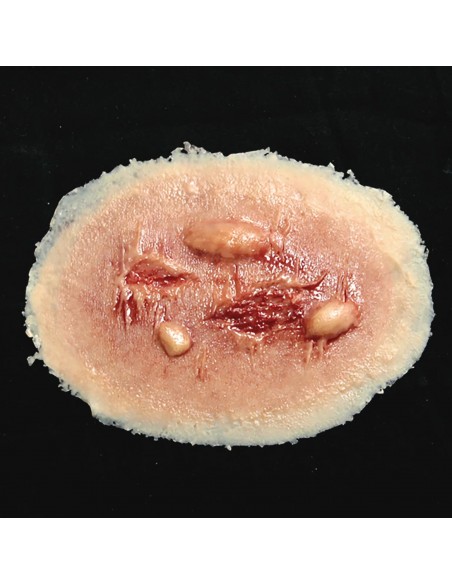 THERMAL BURN- MEDIUM