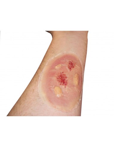 Vidutinė Terminio Nudegimo Imitacija